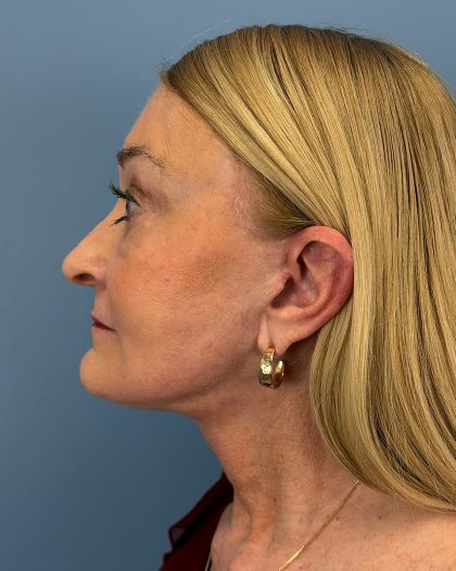 Facelift and Necklift Before & After Patient #16514