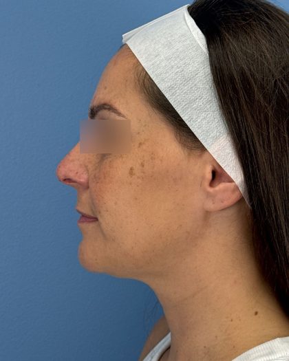 Rhinoplasty Before & After Patient #16563