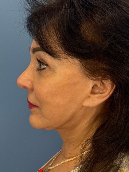 Browlift Before & After Patient #16464