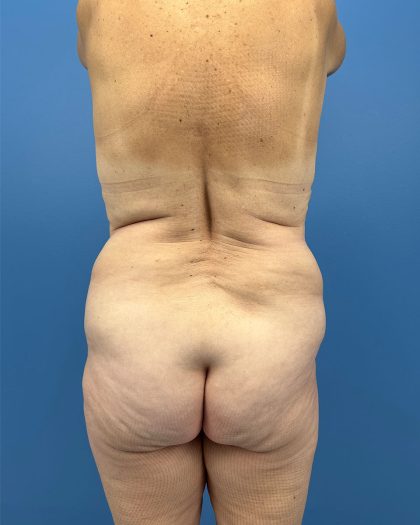 Lower Body Lift Before & After Patient #16479