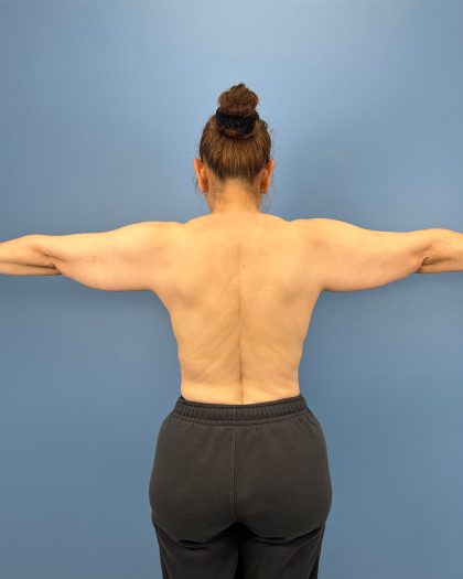 Arm Lift Before & After Patient #16428