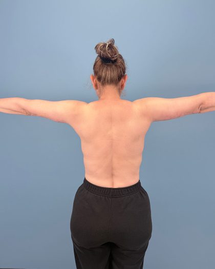 Arm Lift Before & After Patient #16428