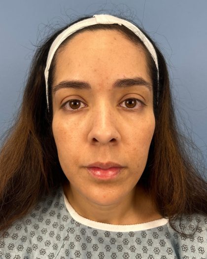 Browlift Before & After Patient #16455