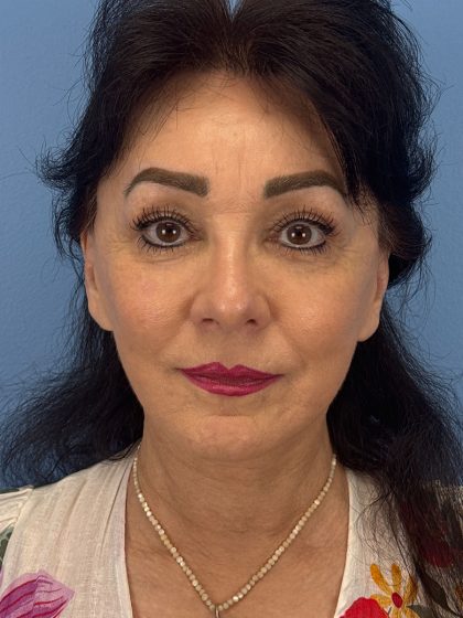 Browlift Before & After Patient #16464
