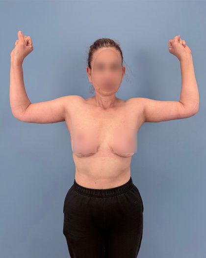 Arm Lift Before & After Patient #16428