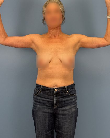 Arm Lift Before & After Patient #16492