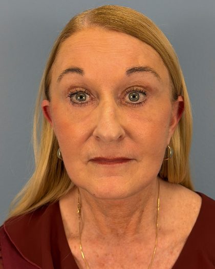 Facelift and Necklift Before & After Patient #16514