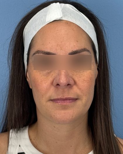 Rhinoplasty Before & After Patient #16563