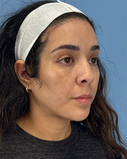 Browlift Before & After Patient #16455