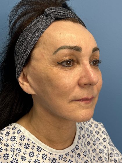 Browlift Before & After Patient #16464