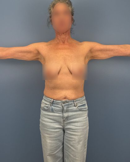 Arm Lift Before & After Patient #16492