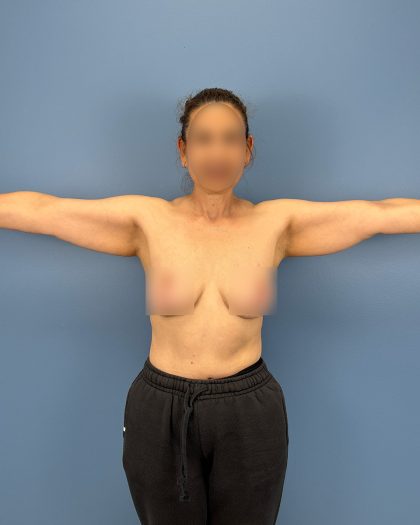 Arm Lift Before & After Patient #16428