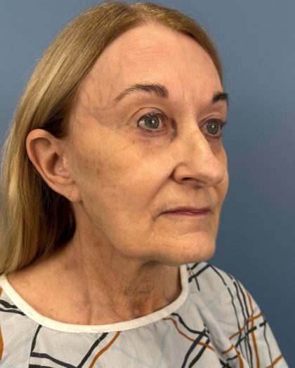 Facelift and Necklift Before & After Patient #16514