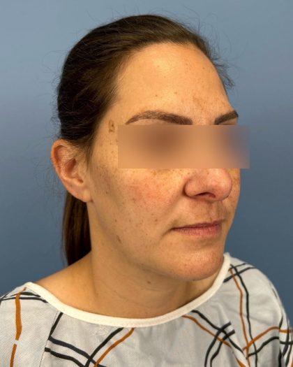 Rhinoplasty Before & After Patient #16563