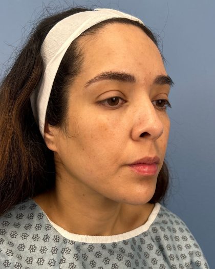 Browlift Before & After Patient #16455