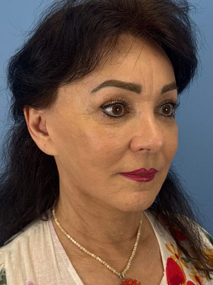 Browlift Before & After Patient #16464