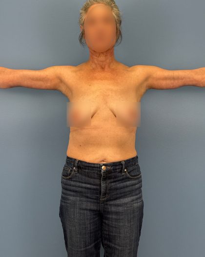Arm Lift Before & After Patient #16492