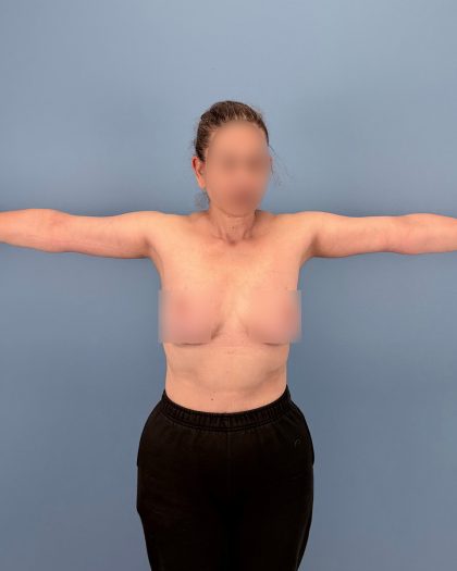Arm Lift Before & After Patient #16428