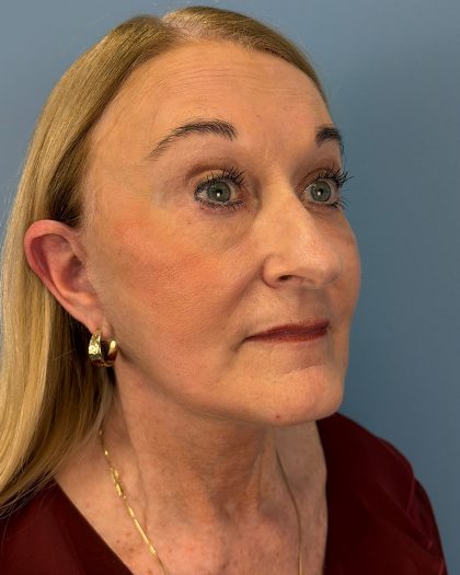 Facelift and Necklift Before & After Patient #16514