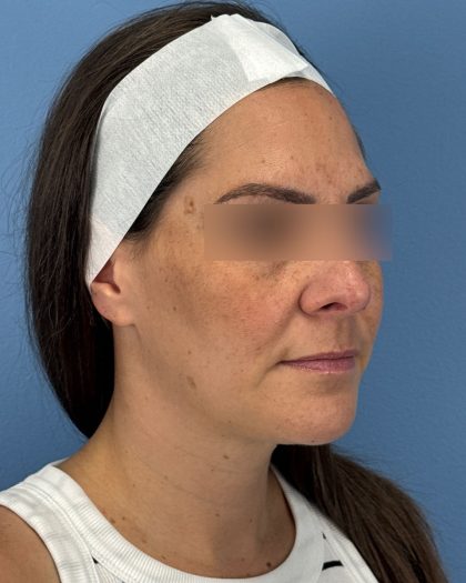 Rhinoplasty Before & After Patient #16563