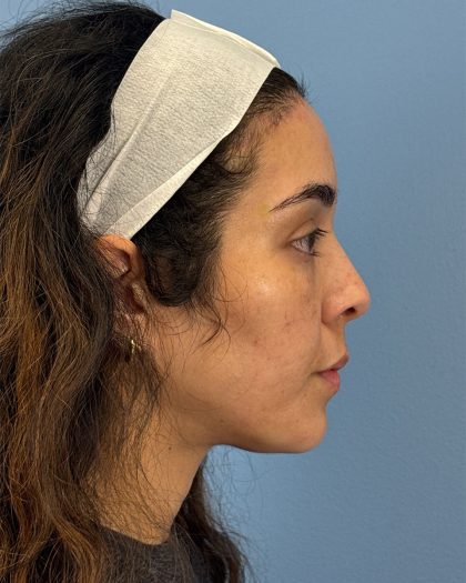 Browlift Before & After Patient #16455