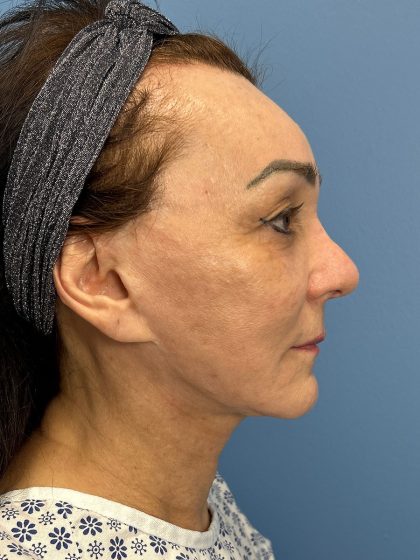 Browlift Before & After Patient #16464