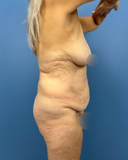 Lower Body Lift Before & After Patient #16479