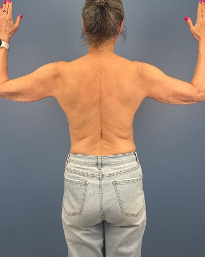 Arm Lift Before & After Patient #16492