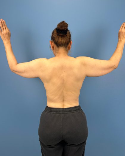 Arm Lift Before & After Patient #16428