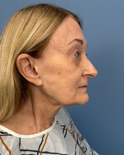Facelift and Necklift Before & After Patient #16514