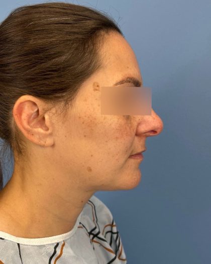 Rhinoplasty Before & After Patient #16563
