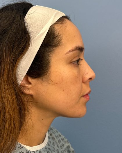 Browlift Before & After Patient #16455