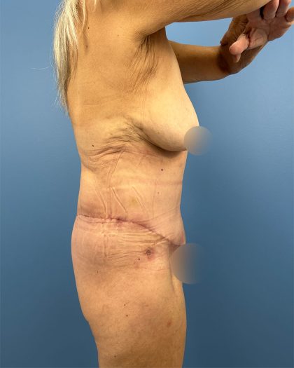 Lower Body Lift Before & After Patient #16479