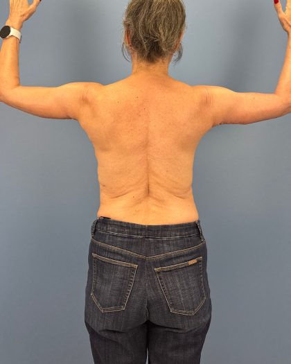 Arm Lift Before & After Patient #16492