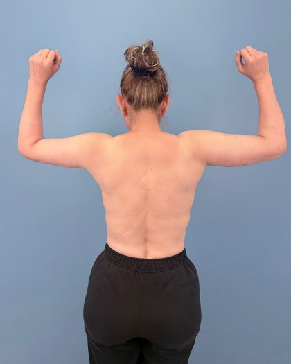 Arm Lift Before & After Patient #16428