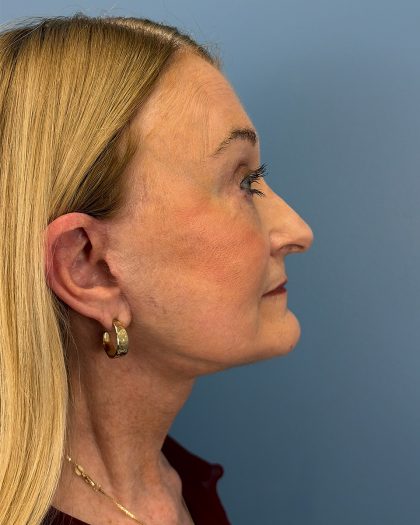 Facelift and Necklift Before & After Patient #16514