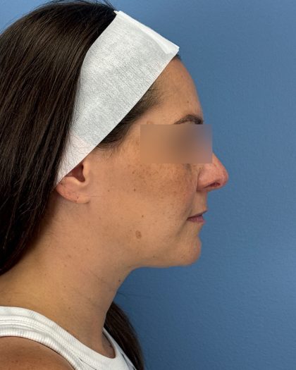 Rhinoplasty Before & After Patient #16563