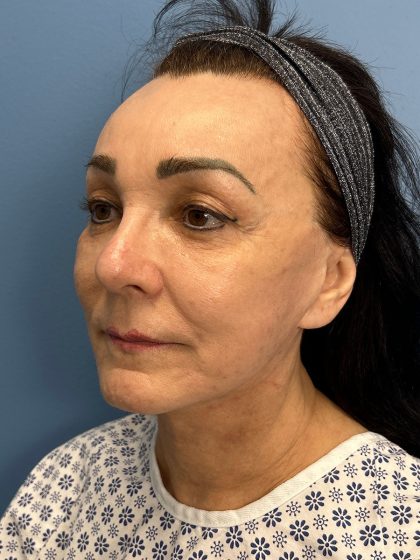 Browlift Before & After Patient #16464