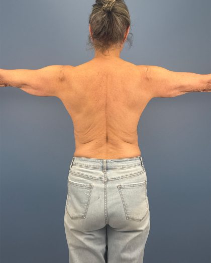 Arm Lift Before & After Patient #16492