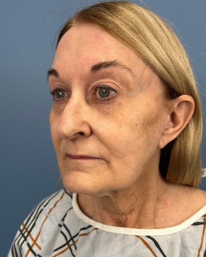 Facelift and Necklift Before & After Patient #16514