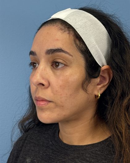 Browlift Before & After Patient #16455