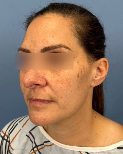 Rhinoplasty Before & After Patient #16563
