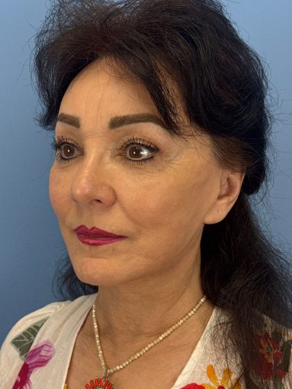 Browlift Before & After Patient #16464