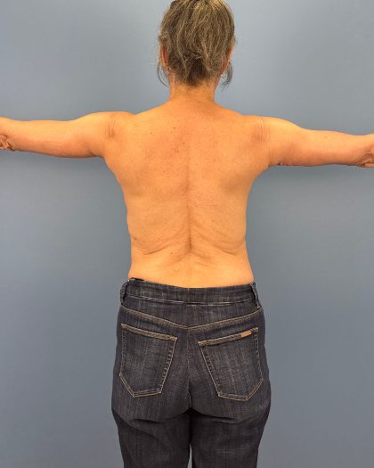 Arm Lift Before & After Patient #16492