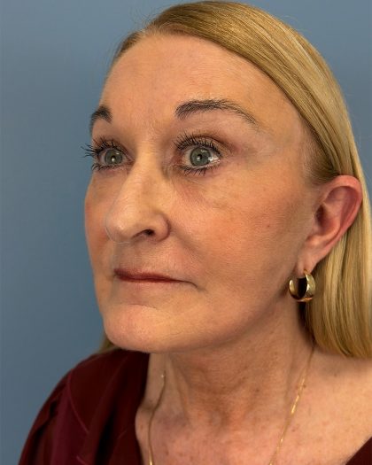 Facelift and Necklift Before & After Patient #16514