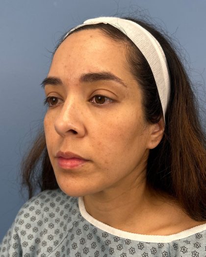 Browlift Before & After Patient #16455