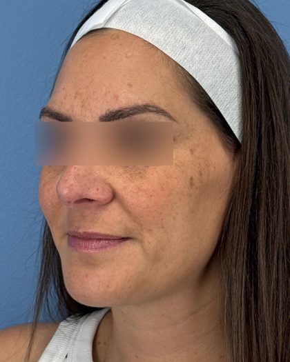 Rhinoplasty Before & After Patient #16563
