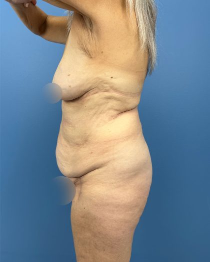Lower Body Lift Before & After Patient #16479