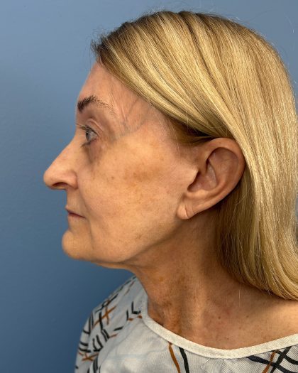Facelift and Necklift Before & After Patient #16514