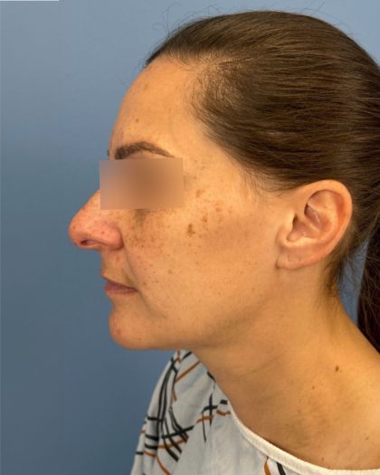 Rhinoplasty Before & After Patient #16563